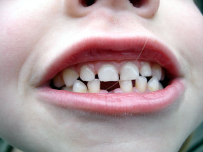 Misha shows off her first missing tooth